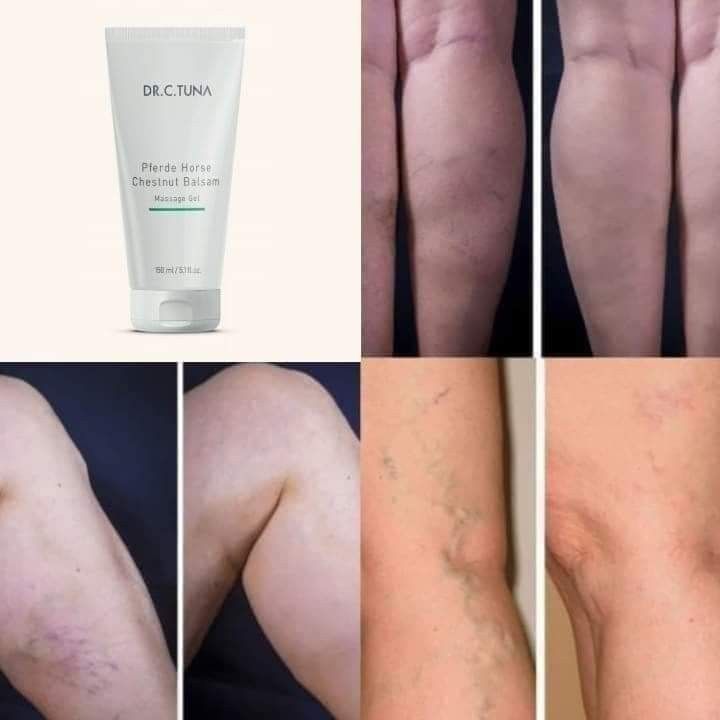 Gel De Castañas para Várices